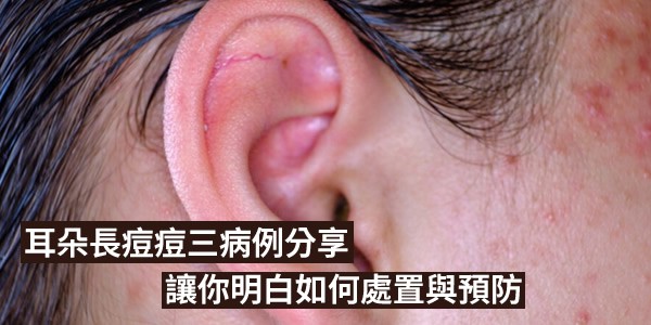 耳朵長痘痘三病例分享，讓你明白如何處置與預防
