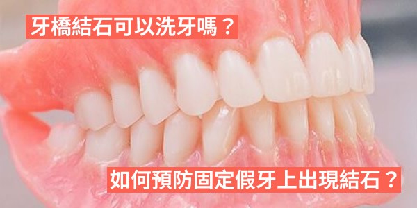 牙橋結石可以洗牙嗎？如何預防固定假牙上出現結石？