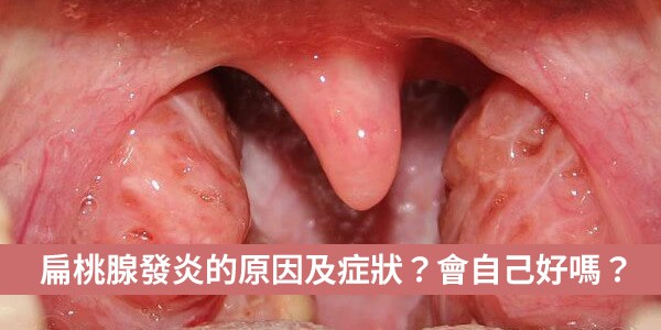 扁桃腺發炎的原因及症狀是什麼？不吃抗生素會自己好嗎？