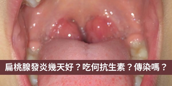 扁桃腺發炎幾天會好？吃何抗生素？扁桃腺炎會傳染嗎？