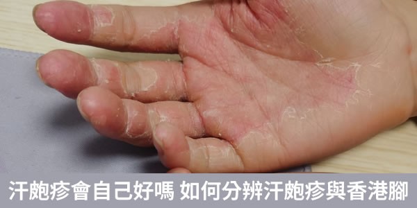 汗皰疹會自己好嗎？ 如何分辨汗皰疹與香港腳？