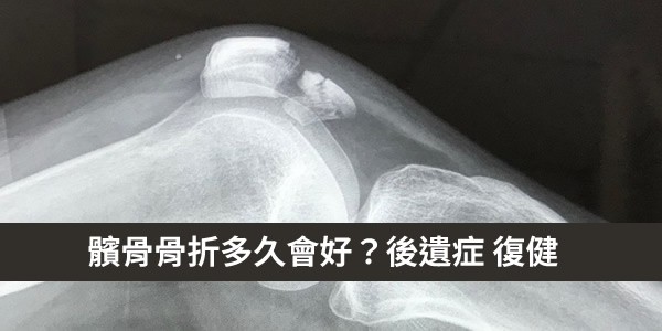 髕骨骨折多久會好？會有後遺症嗎？恢復期復健怎麼做？